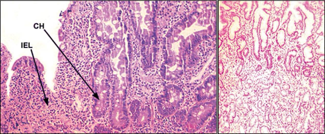 Celiac vs healthy duodenal biopsy comparison